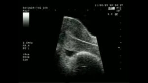 segmented IVF in Mumbai